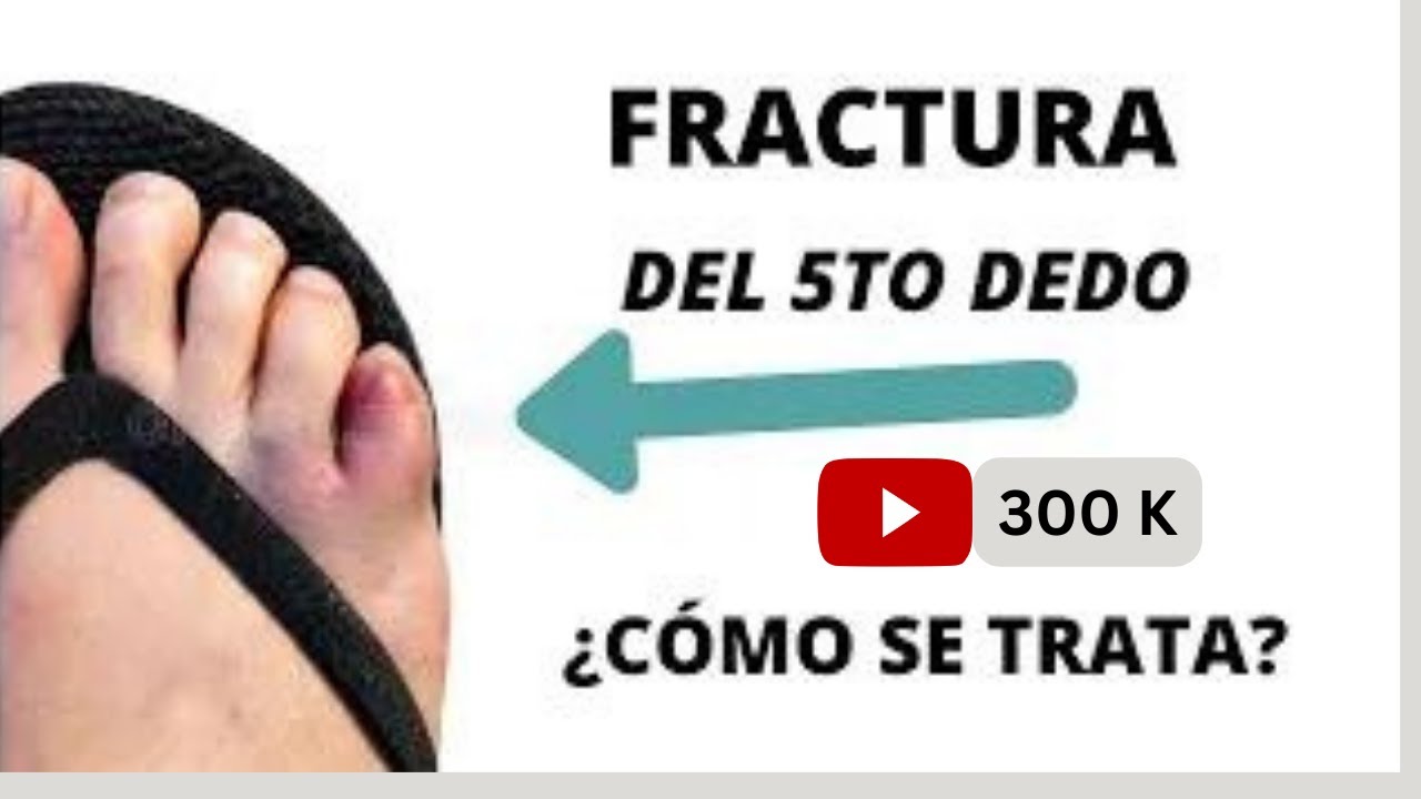 Watch FRACTURA DE QUINTO DEDO DEL PIE ¿COMO TRATARLA Now FRACTURA DE QUINTO DEDO DEL PIE ¿COMO TRATARLA