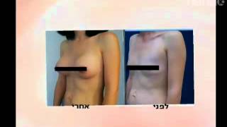 ד"ר אבישי וינברגר - הגדלת חזה ברזילאית