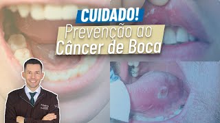 Uma mancha vermelha ou branca na língua ou boca pode ser câncer?