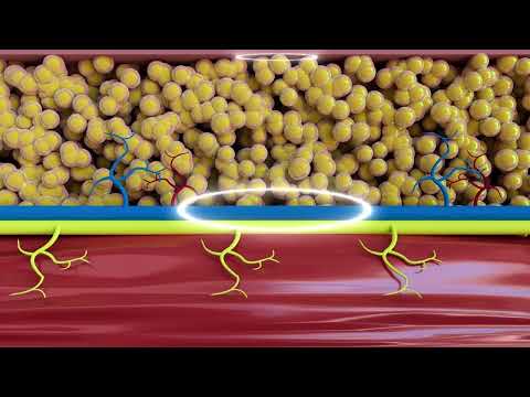 EMS Body Sculpting Machine | How it works to build muscle & reduce fat