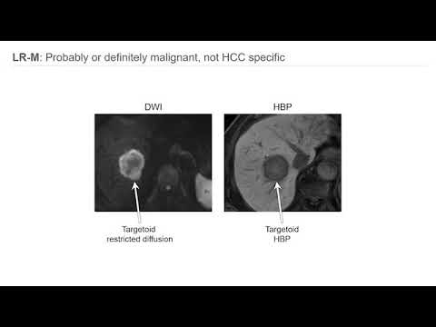 Imaging HCC and LI-RADS