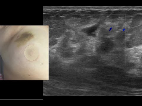 Alterações ultrassonográficas relacionadas à biópsia da mama por agulha grossa / core biopsy