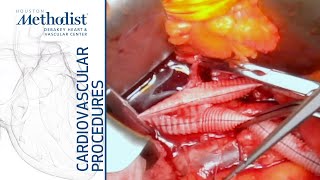 Download Lagu Removal of Infected Stent Graft, Aortobiiliac Rifampin Soaked Graft, IMA Reimplantation (Lumsden MD) Thumbnail