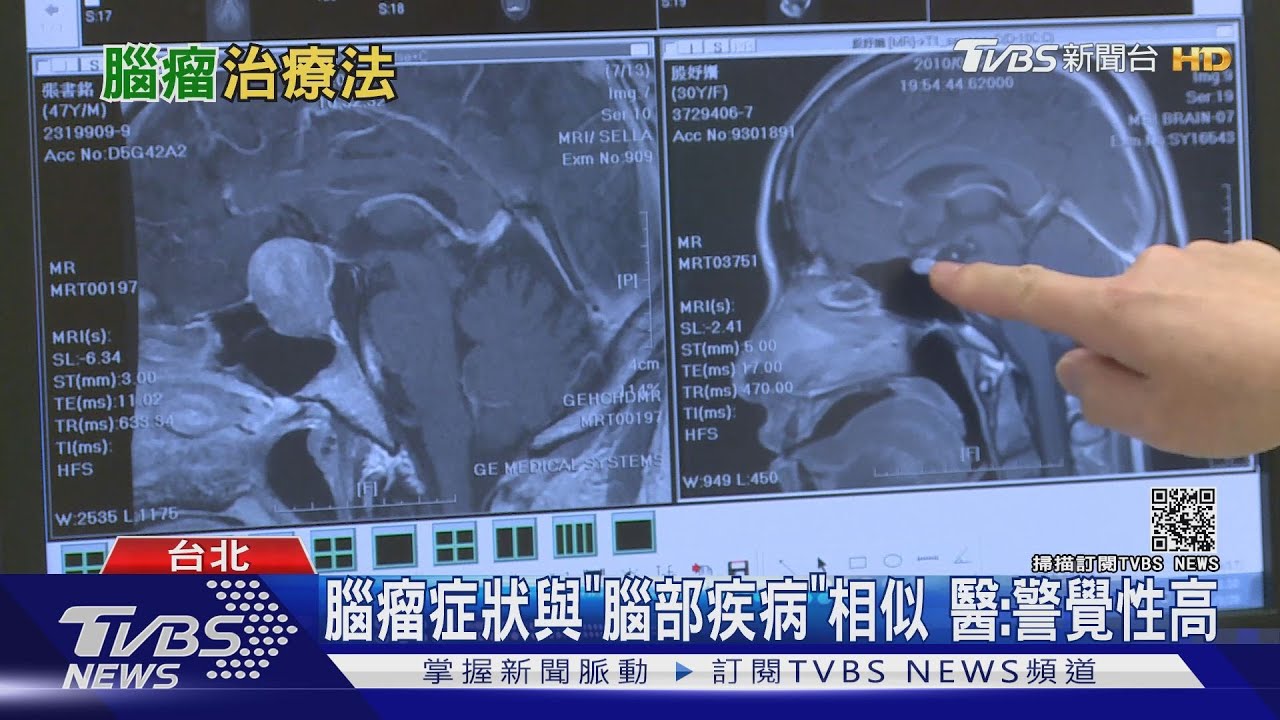 輕忽「這幾個症狀」 醫師:小心「腦瘤」找上你