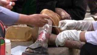 Caring for lepers - http://damientheleper.org