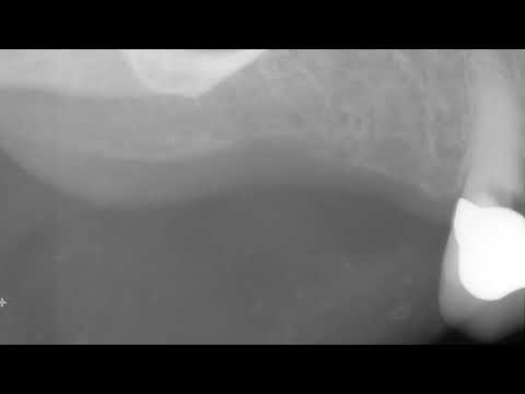 Osteoma Cutis on 2D radiographs