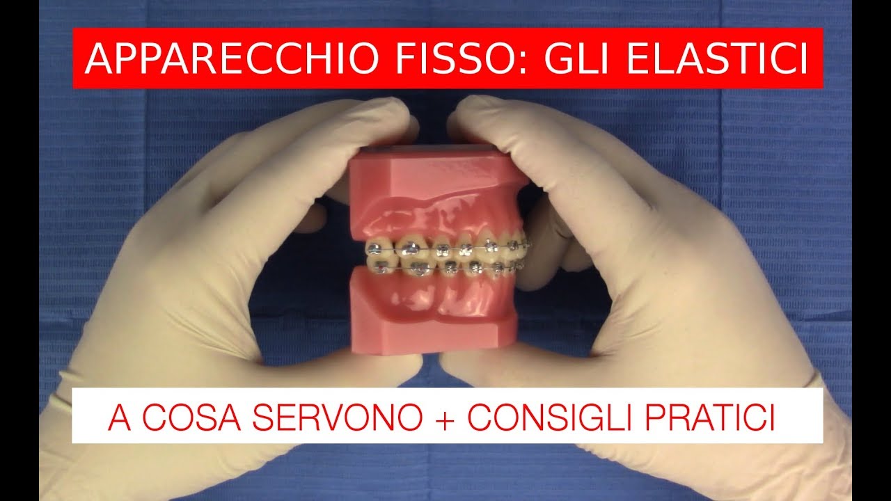 Watch Now Elastici e apparecchio fisso: consigli pratici Elastici e apparecchio fisso: consigli pratici