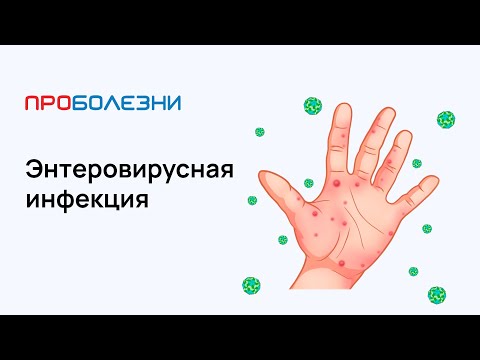 Энтеровирусная инфекция