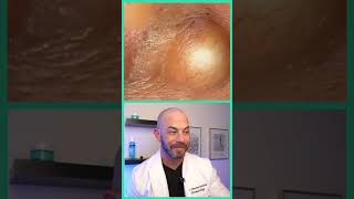 Doctor reacts to juicy cyst pop! #dermreacts #doctorreacts #pimplepop