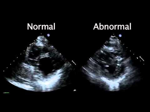 Echocardiogram from the Patient Compared with That from a Normal Control | NEJM
