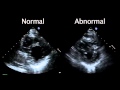Echocardiogram from the Patient Compared with That from a Normal Control | NEJM