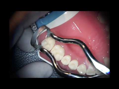 Tips and tricks στη χρήση του ελαστικού απομονωτήρα (Dental TTT - Webinar No14).