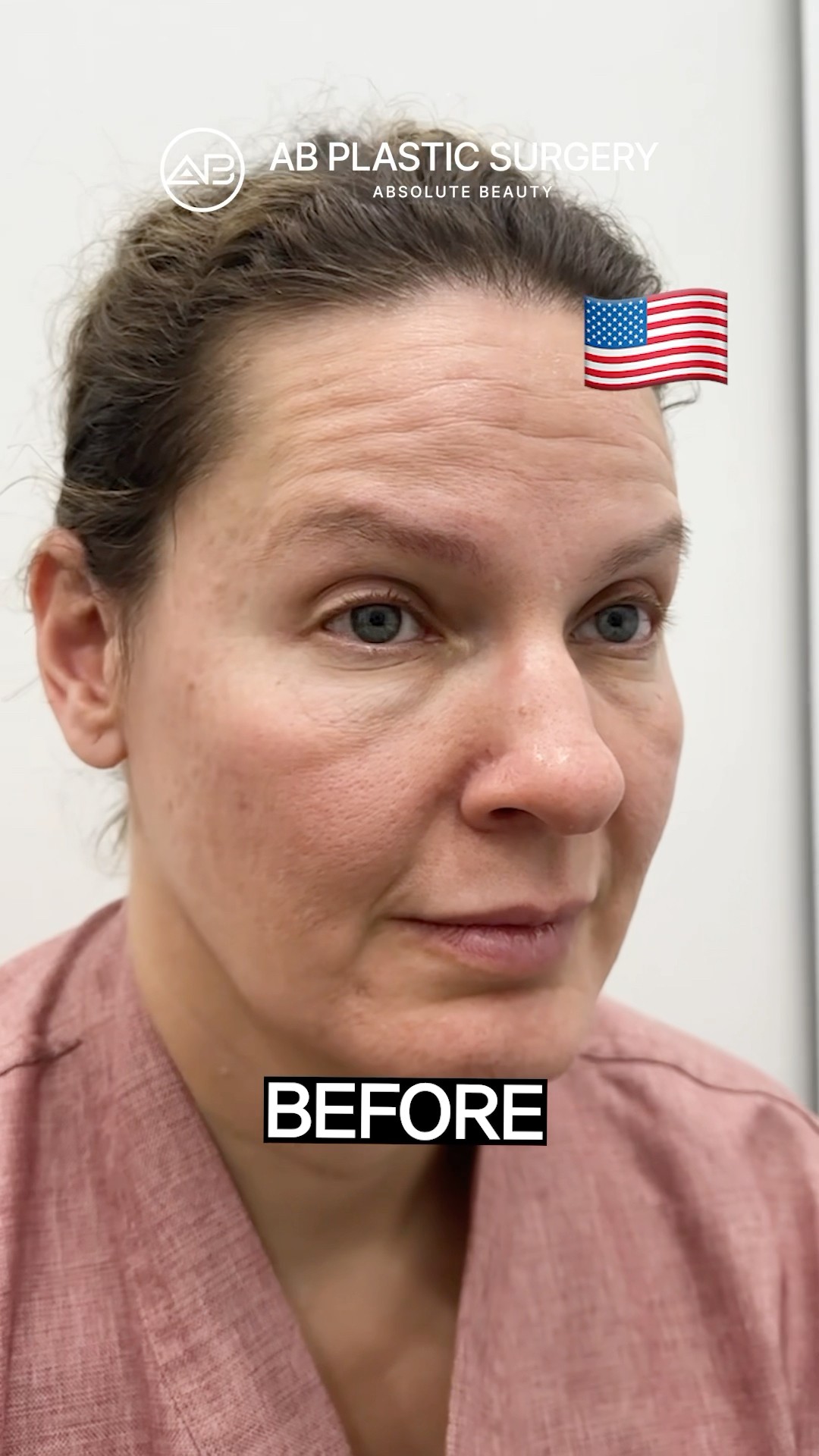 Say Goodbye to Wrinkles with a Full Facelift