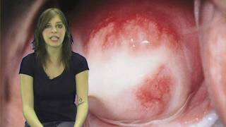 STDs, Sexually Transmitted Disease 1, Chlamydia Infection Symptoms Hot Facts Girl Kayleigh