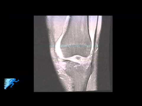 How to Read Knee MRI of Medial Meniscus Tear 