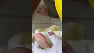 Ep_8301 Ingrown toenail removal 👣 ถ้าหนูไม่ทำแผล..อาจจะต้องถอดเล็บ 😄 (clip from Thailand)
