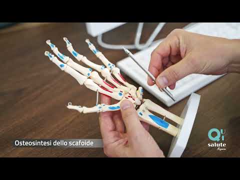 Frattura dello scafoide: qual è la soluzione migliore?