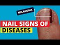 10 Nail Signs of Health Problems (Subungual Melanoma, Finger Clubbing, Nail Pitting, Brittle Nails)