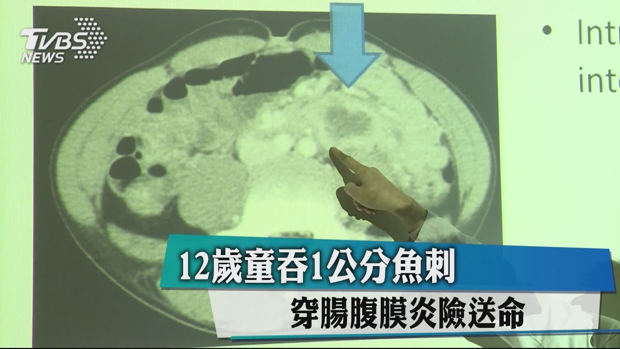 12歲童吞1公分魚刺 穿腸腹膜炎險送命