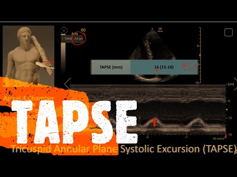 Measure TAPSE or TAM. Perioperative & Critical Care ECHO / POCUS