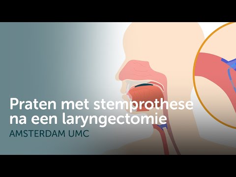 Praten met een stemprothese na een laryngectomie