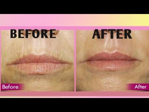 Treat DEEP wrinkles around the MOUTH AREA-The...