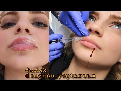 download lagu mp3 mp4 Dudak Dolgusu Izmir, download lagu Dudak Dolgusu Izmir gratis, unduh video klip Dudak Dolgusu Izmir