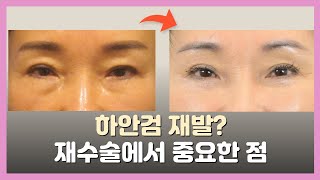 겹쌍꺼풀 고민? 해결 방법 알려드려요!