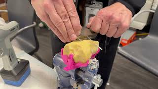 Fulkerson Osteotomy for Patella Subluxation