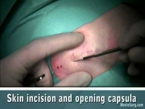 lipoma surgery
