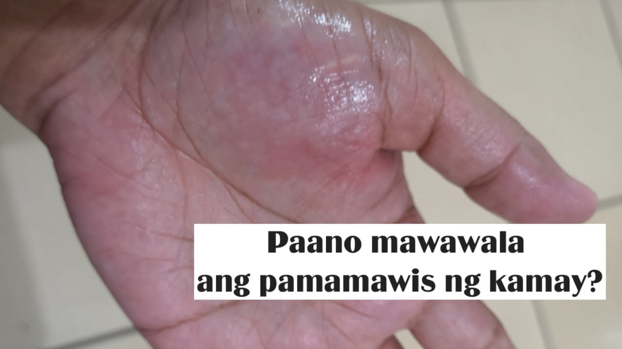 Putar video Gamot sa pamamawis ng kamay at paa | Home Remedies sekarang Gamot sa pamamawis ng kamay at paa | Home Remedies