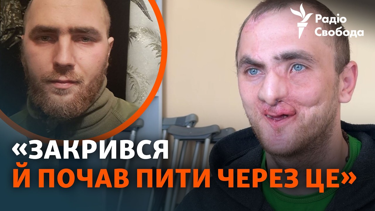 Втратив пів обличчя на війні, шансу виправити не було: історія військового з 