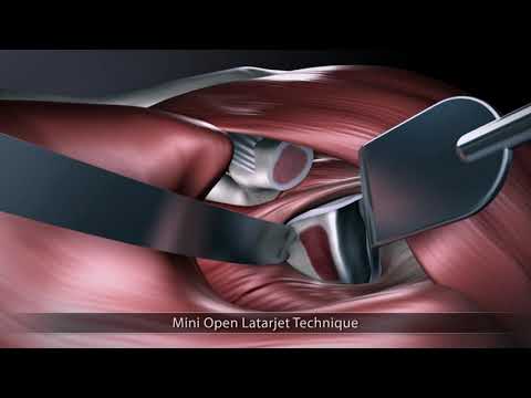 Mini Open Latarjet Technique