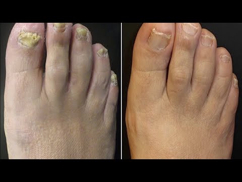 Ekzoderil mula sa kuko halamang-singaw review presyo sa Irkutsk Unguento ng halamang-singaw sa ari ng lalaki