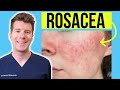 Doctor Explains ROSACEA Skin Condition Causes Treatment And More