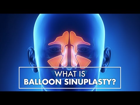 What Is Balloon Sinuplasty? | Dr. Marc Dean | Top10MD