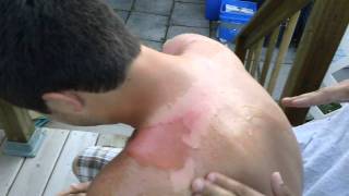 The worst sunburn ever...