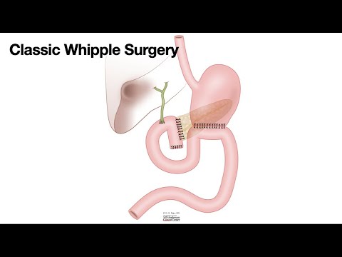 HCC 1475-10e-Surgical Anatomy-Classic Whipple