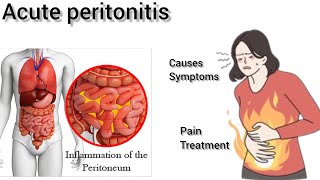 acute peritonitis| acute abdomen #surgeryday