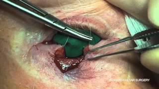 3snipandwedgeresection