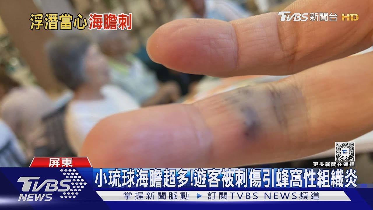 手上扎滿10幾根海膽刺! 小琉球浮潛遊客遭刺傷
