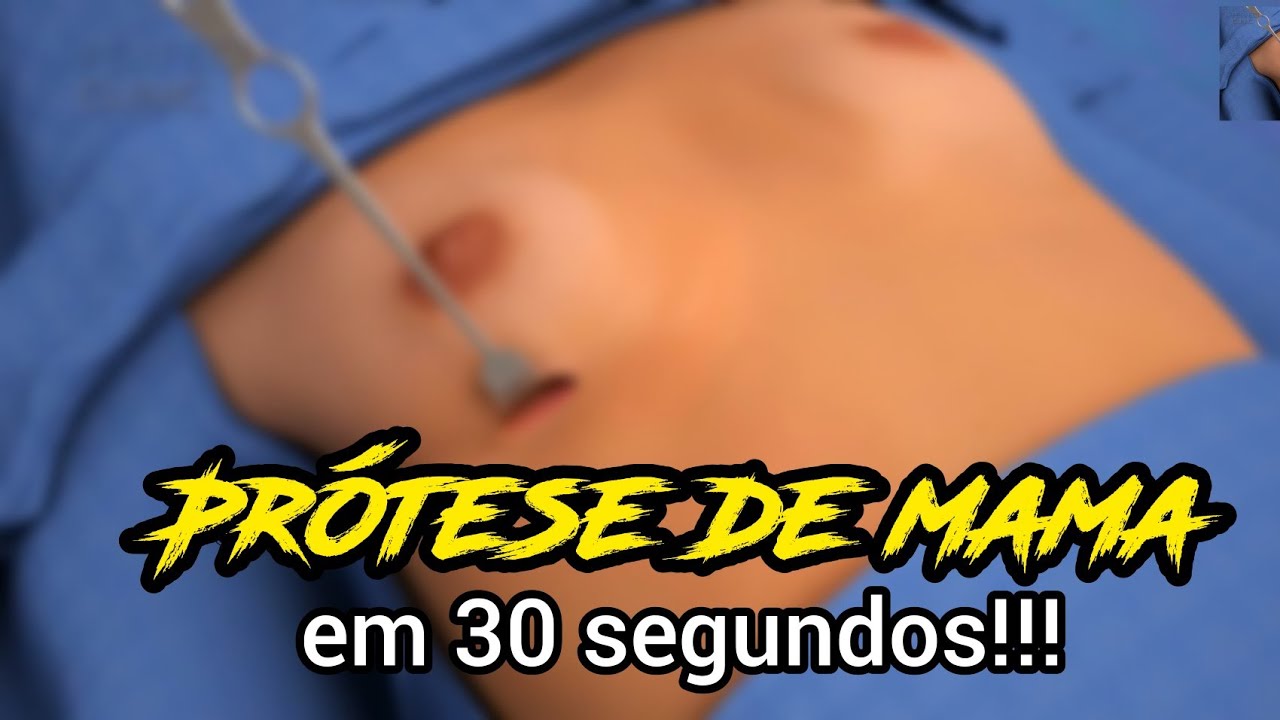 Watch Now PROTESE DE SILICONE antes e depois!!! PROTESE DE SILICONE antes e depois!!!