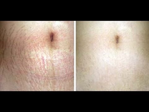 Rückenschmerzen, wenn Sie sich hinlegen Lade Übung mit zervikaler Osteochondrose