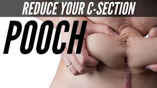 How To Reduce C-Section Belly Pouch | REDUCE C-SECTION BULGE WITH SCAR MASSAGE
