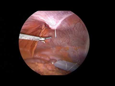 Operación laparoscópica de hernia umbilical- el método IPOM simplificado