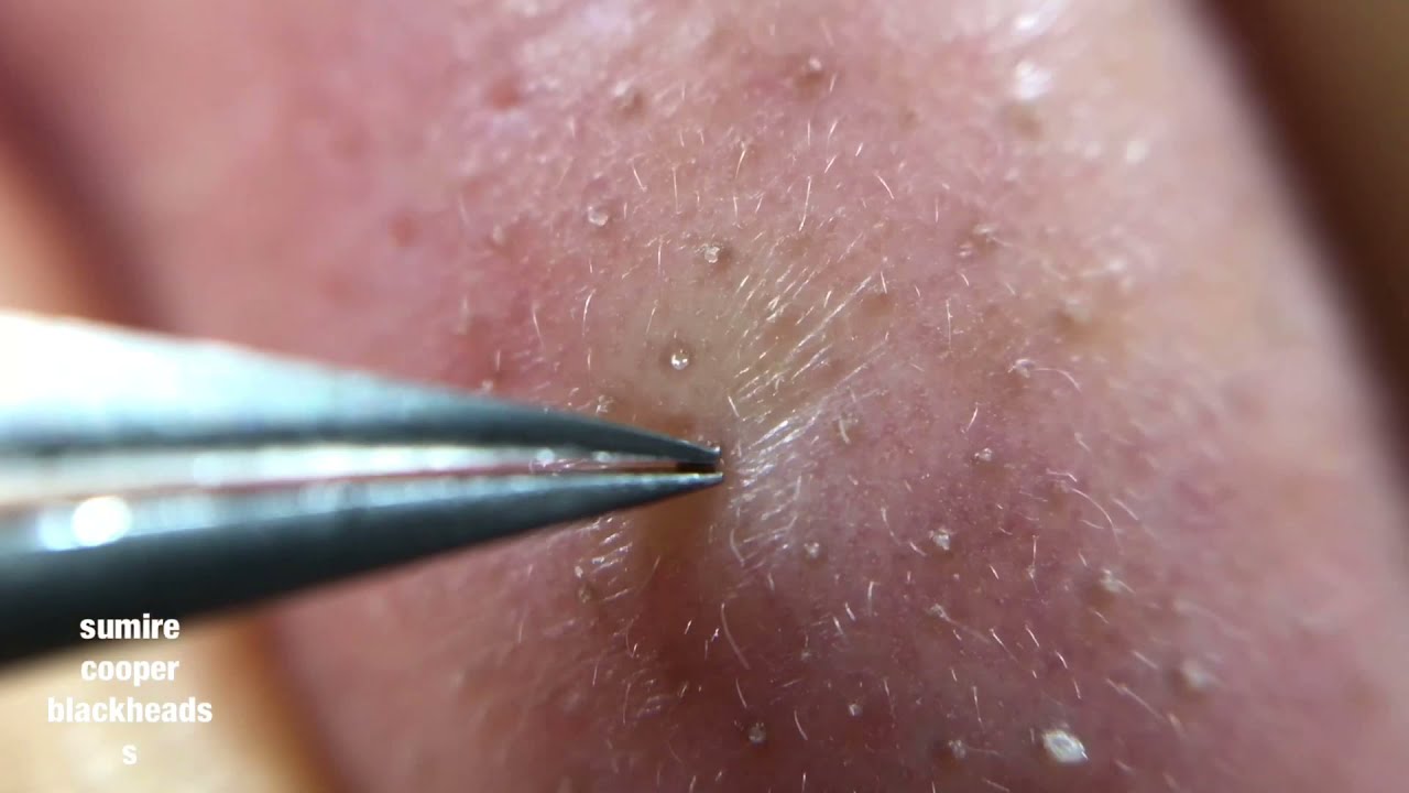 鼻角栓126 nose blackheads★tweezers only★