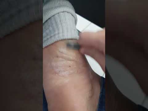 Tratamento de crianças de dermatite de atopic Psoríase e o seu tratamento de medicina