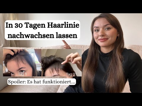 In 30 Tagen Haaransatz und Geheimratsecken nachwachsen lassen. Hat es funktioniert?