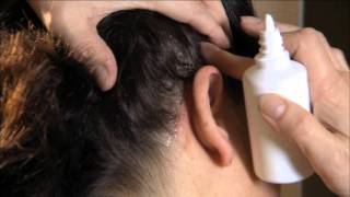 Psoriasis en Cuero Cabelludo 💇 Aplicación de Tratamientos Tópicos