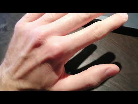 Beyond PSSD: James Shows His Post SSRI Hand Tremor 5 Years Since Stopping Prozac